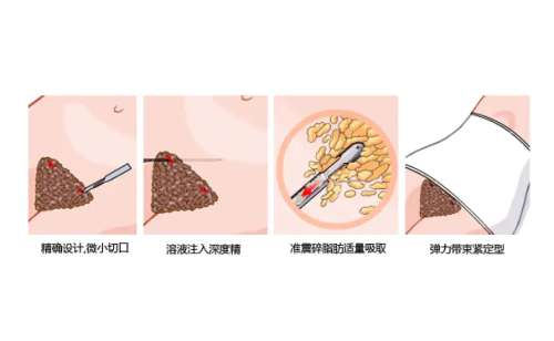 吸脂1.jpg
