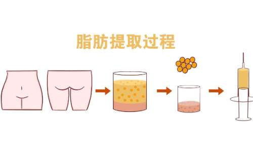 脂肪填充.jpg