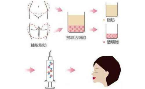 脂肪填充1.jpg
