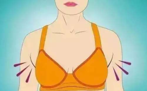去副乳.jpg