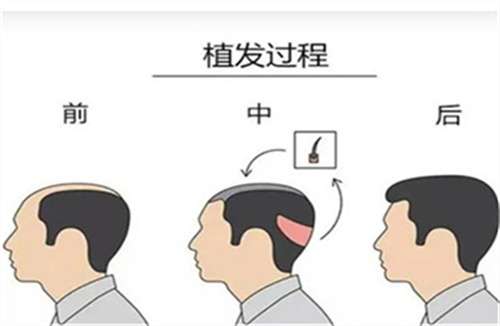 植发12.jpg