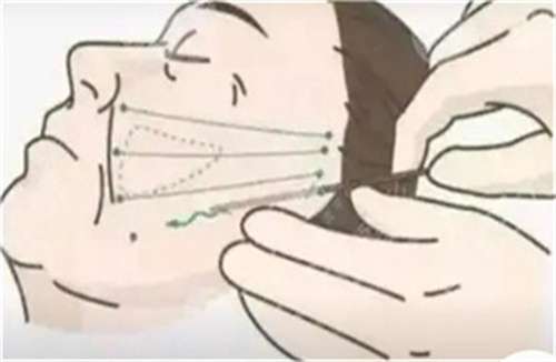 拉皮11.jpg