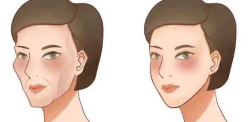 面部填充 面部填充