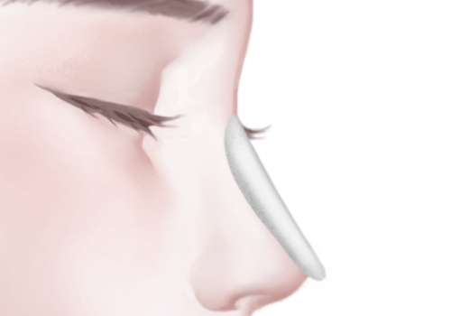 硅胶隆鼻.jpg