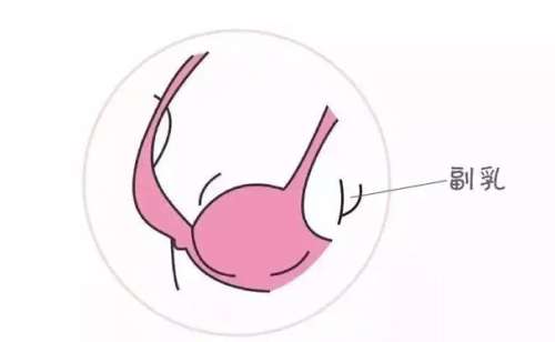 去副乳1.jpg