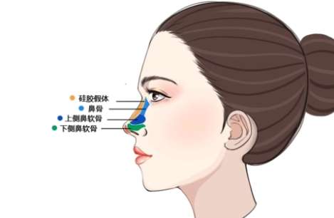 膨体隆鼻 膨体隆鼻