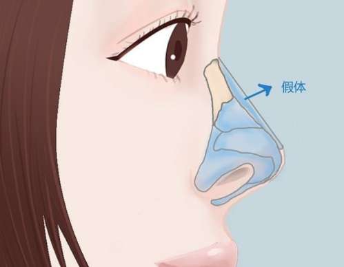 隆鼻 隆鼻