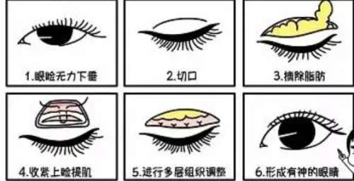 双眼皮修复原理图.jpg