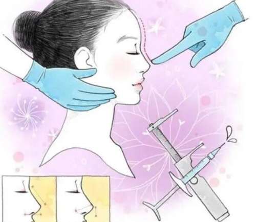隆鼻 隆鼻