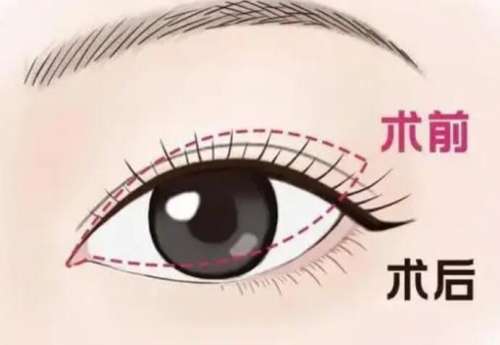 双眼皮dm8.jpg