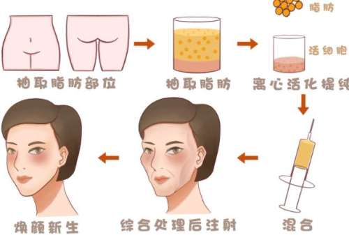 脂肪填充01.jpg