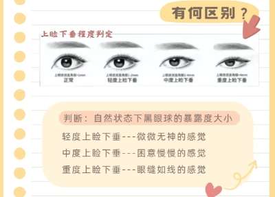 双眼皮 双眼皮