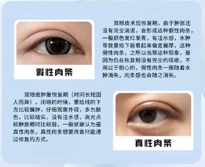 双眼皮 双眼皮