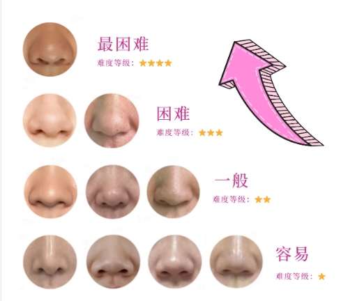 隆鼻 隆鼻