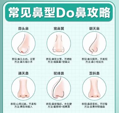 隆鼻 隆鼻