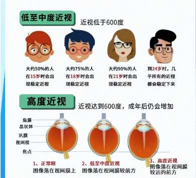 近视眼 近视眼
