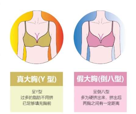 隆胸 隆胸