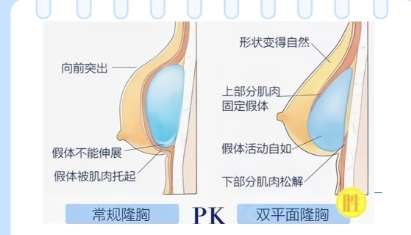 隆胸 隆胸