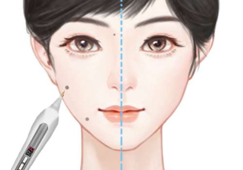 激光点痣.jpg