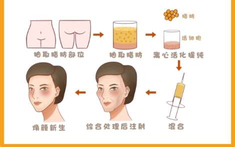 自体脂肪填充面部 自体脂肪填充面部