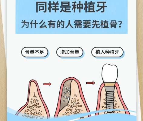 牙齿种植 牙齿种植