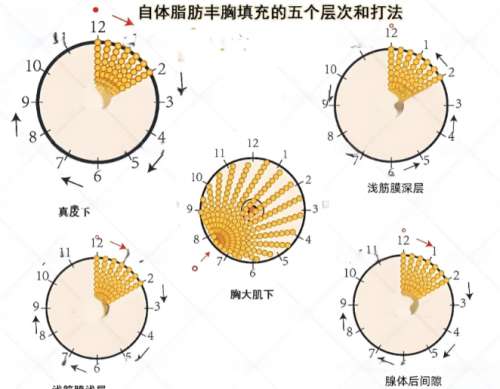 隆胸 隆胸