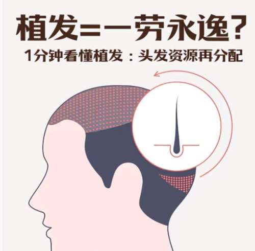 植发 植发