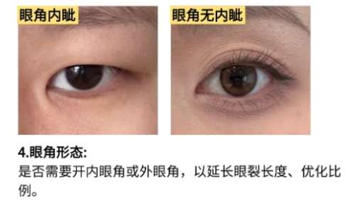 双眼皮 双眼皮