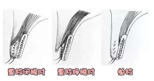 双眼皮 双眼皮