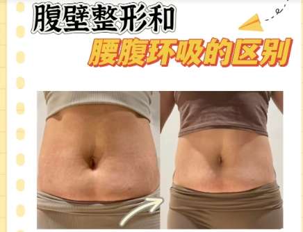 吸脂 吸脂