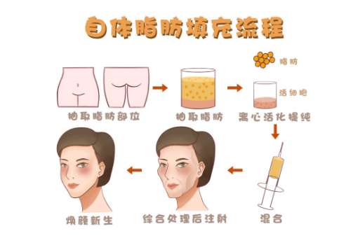 脂肪填充4.jpg