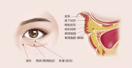 眼袋1.jpg 眼袋1.jpg