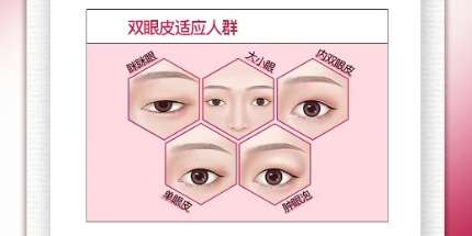 双眼皮 双眼皮