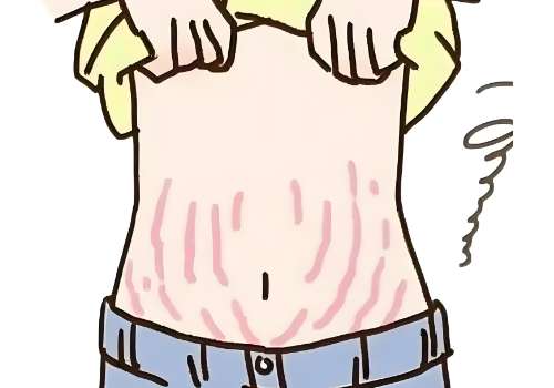 腹壁整形2.jpg