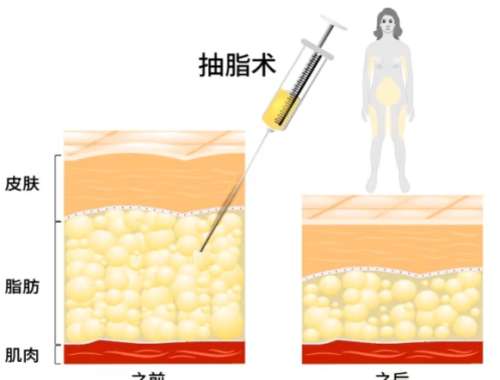 吸脂 吸脂
