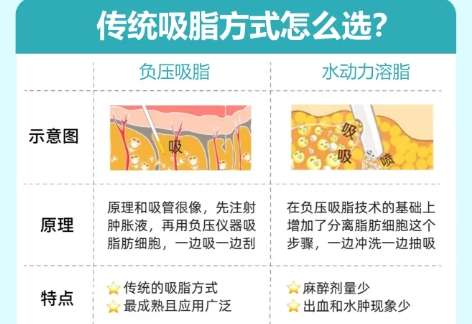 吸脂 吸脂