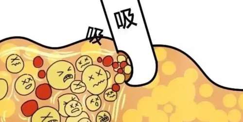 吸脂 吸脂