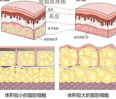 吸脂 吸脂