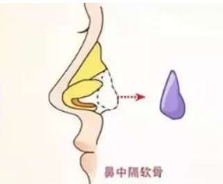 隆鼻 隆鼻