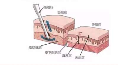吸脂 吸脂