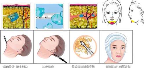 吸脂 吸脂