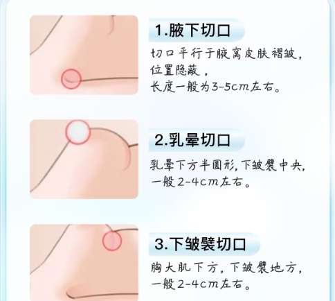 隆胸 隆胸