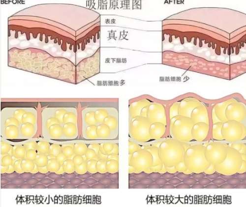 吸脂 吸脂
