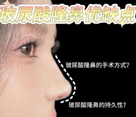 隆鼻 隆鼻