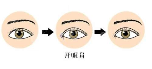 开眼角 开眼角