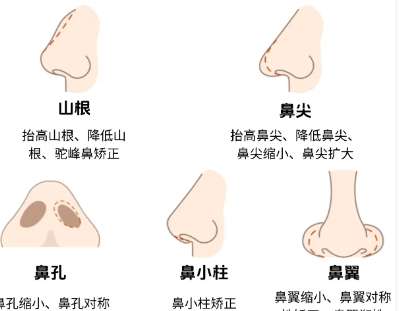 隆鼻 隆鼻