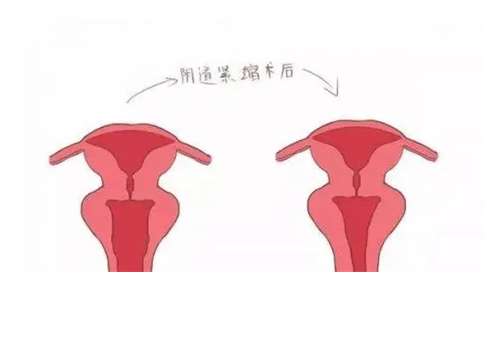 阴道缩紧.jpg