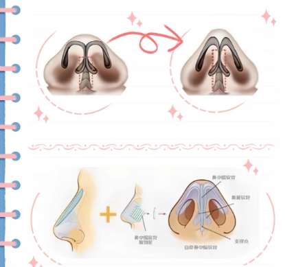 隆鼻 隆鼻