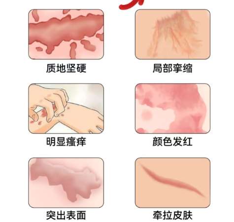 祛疤 祛疤