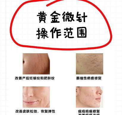 黄金微针 黄金微针
